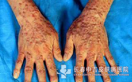 导致扁平疣患病的主要原因都有哪一些？