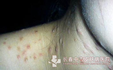 皮肤上患上扁平疣后日常护理工作怎么做？