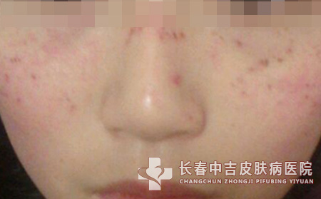 雀斑患者在饮食的注意事项