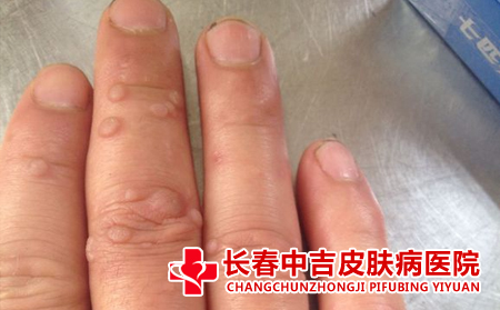 扁平疣给患者带来的危害