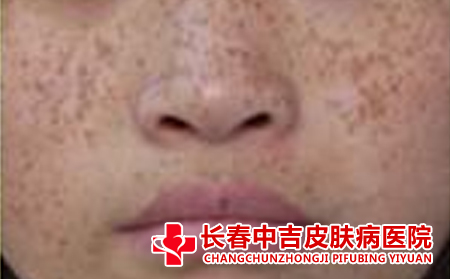 雀斑形成的原因