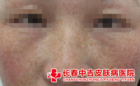 什么原因导致雀斑加重