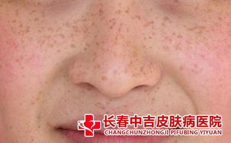 雀斑孕妈妈孕期注意什么