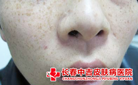 男性雀斑患者的注意事项
