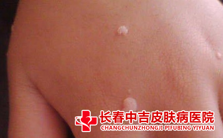 患了扁平疣的原因