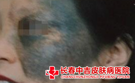 长春治疗太田痣,治疗太田痣的医院