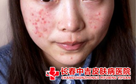怎样预痤疮的复发