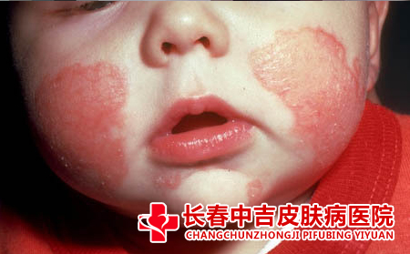 宝宝湿疹怎么护理