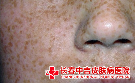 夏季雀斑的预防方法