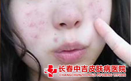 痤疮患者吃什么肉比较不错