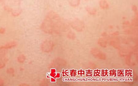 荨麻疹有什么症状