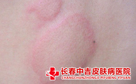 荨麻疹有什么症状