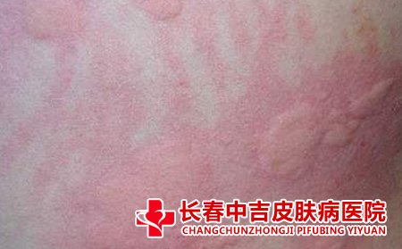 荨麻疹患者会有什么变化