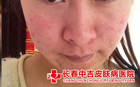 青春期长痤疮应该注意什么