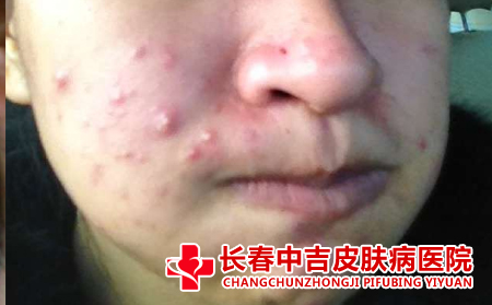 去角质对痤疮患者有没有影响
