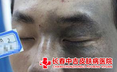 长春治疗太田痣效果合适的医院是哪家