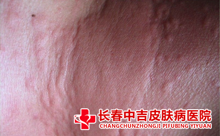 长春治疗荨麻疹效果合适的医院是哪一家
