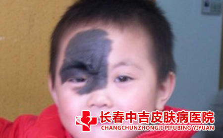 青胎记治疗,长春治疗青胎记