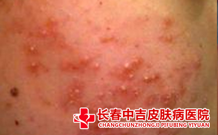 什么样的护理合适有助于痤疮的恢复