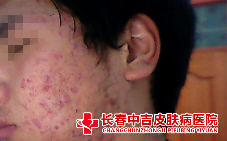 痤疮的症状有什么