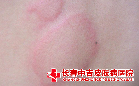 荨麻疹患者的饮食禁忌