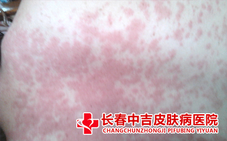 皮肤瘙痒的病因,皮肤瘙痒有哪些原因