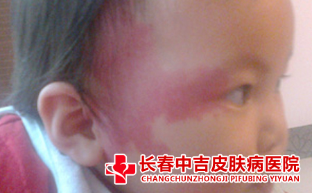 胎记的危害是什么,胎记的并发症