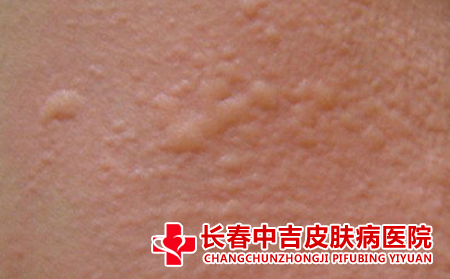 荨麻疹的预防方式