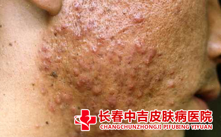 痤疮应该怎么进行预防
