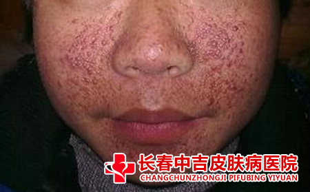 三伏天如何正确的护理痤疮