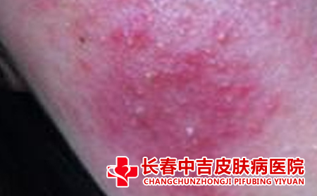 皮肤瘙痒患者的饮食怎么进行护理