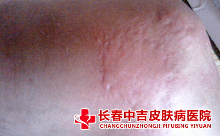 解决皮肤瘙痒有什么办法