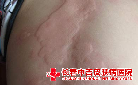 荨麻疹患者如何洗澡比较不错