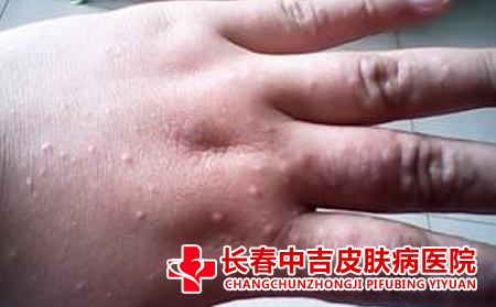 扁平疣怎么传染