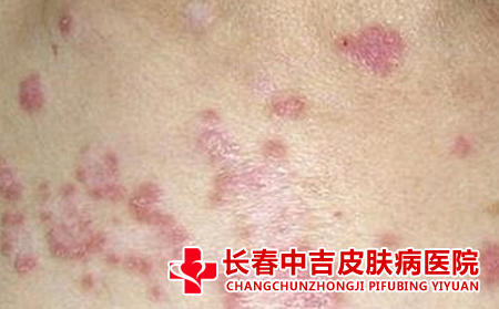 荨麻疹患者怎么吃比较不错