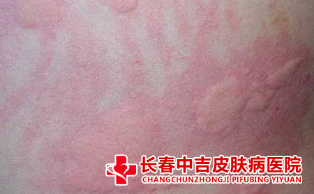 荨麻疹患者的日常护理