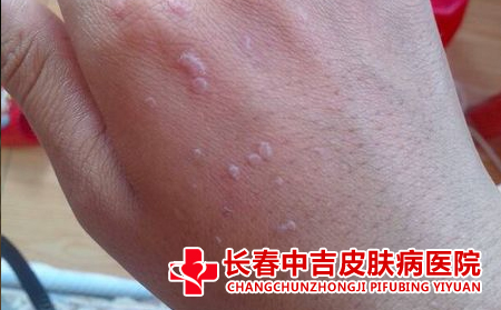 扁平疣患者怎么进行护肤