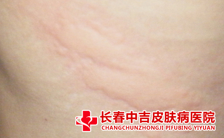荨麻疹怎么进行日常护理