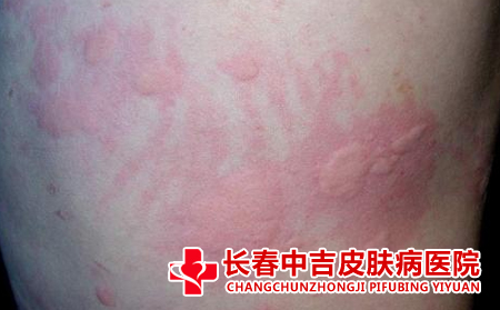 导致荨麻疹反复的原因有什么