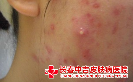 痤疮患者的日常护理