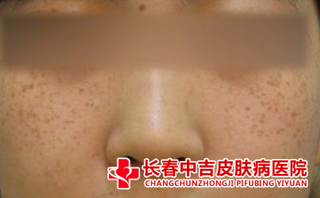 怎么预防雀斑的发生