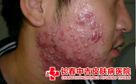 痤疮患者在饮食上注意什么