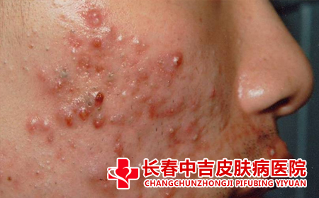 脸上长痤疮皮肤会有什么变化