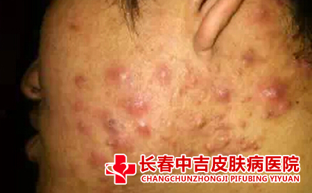 导致面部出现痤疮的原因有什么