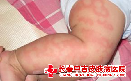 皮肤过敏的小常识