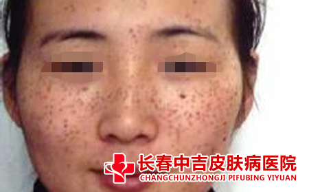 长春激光祛斑比较不错的医院