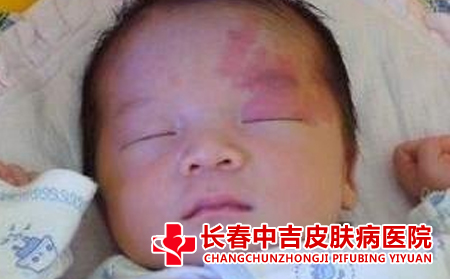 胎记可不可能中年再长出来