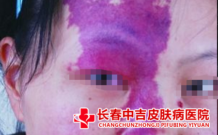 导致胎记的原因有什么