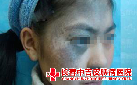 太田痣护理的方法有什么