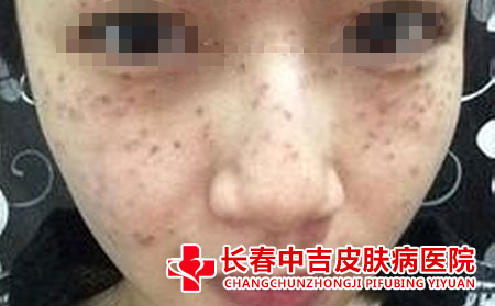雀斑患者应该怎么进行护理